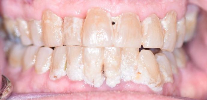 Periodontal Cleaning Case 8 - Cuero, TX - Before