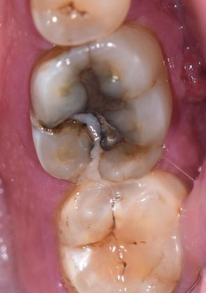 Dental Implants Case 3 - Cuero, TX - Before