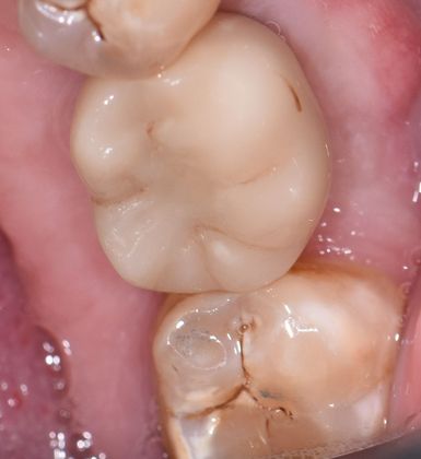 Dental Implants Case 3 - Cuero, TX - After