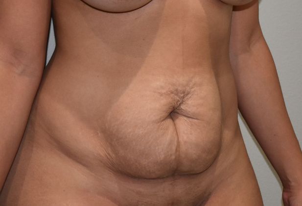 Tummy Tuck (Abdominoplasty): Case 3 - Before
