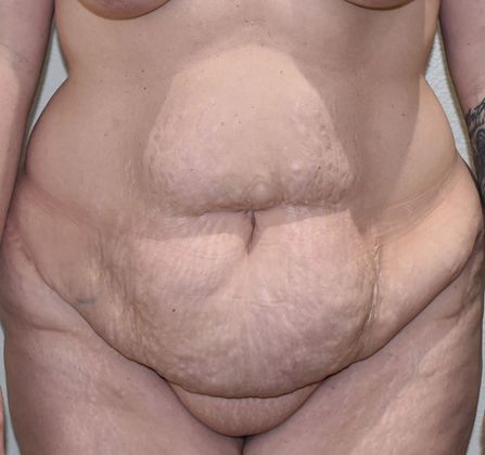 Tummy Tuck (Abdominoplasty): Case 245 - Before