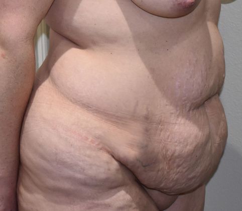 Tummy Tuck (Abdominoplasty): Case 245 - Before