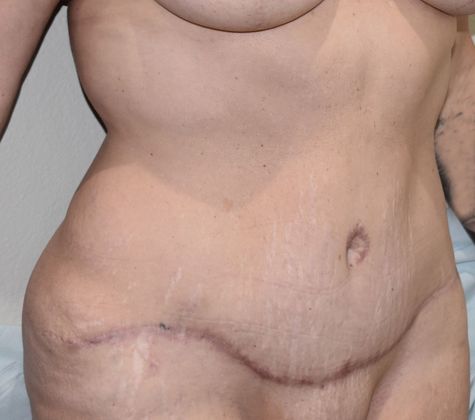 Tummy Tuck (Abdominoplasty): Case 245 - After