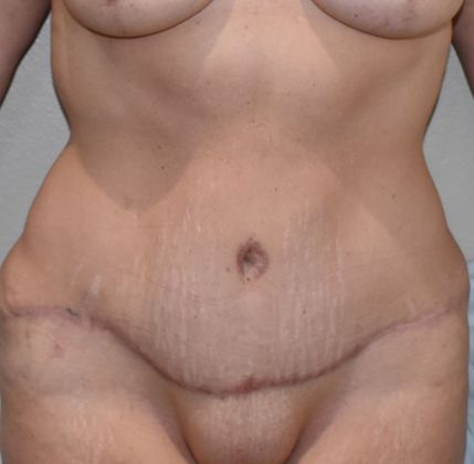 Tummy Tuck (Abdominoplasty): Case 245 - After