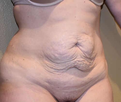 Tummy Tuck (Abdominoplasty): Case 246 - Before