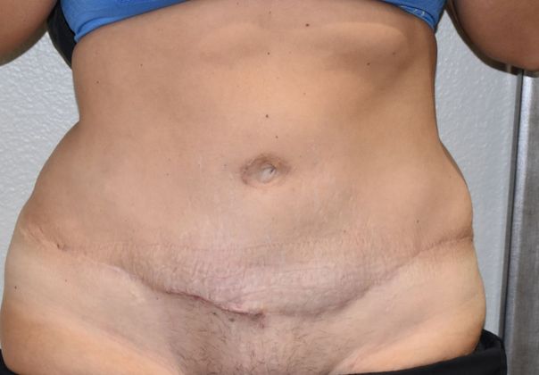 Tummy Tuck (Abdominoplasty): Case 246 - After
