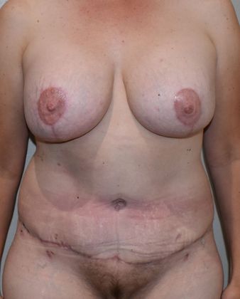 Mommy Makeover Case 170 - After