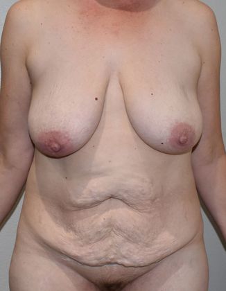 Mommy Makeover Case 170 - Before