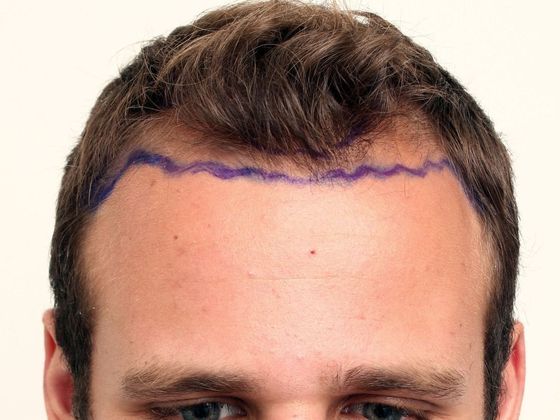 Hair Transplant - Male: Hairline FUE - Case 1 - Before FUE hair transplant