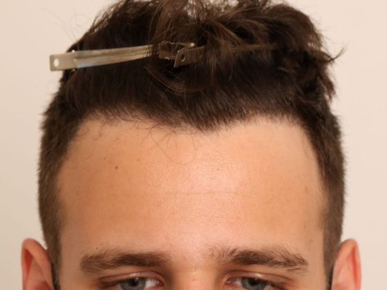 Hair Transplant - Male: Hairline FUE - Case 1 - After FUE hair transplant