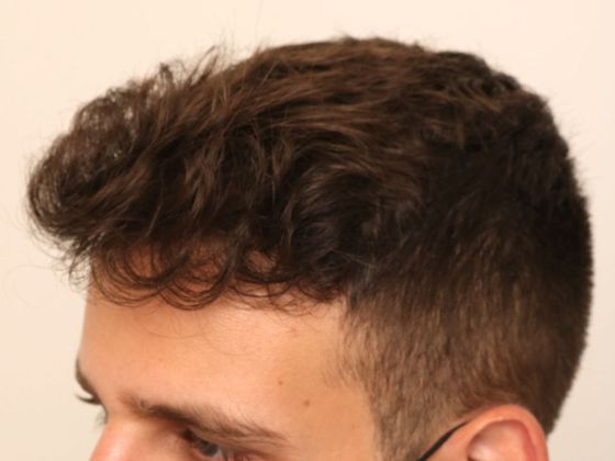 Hair Transplant - Male: Hairline FUE - Case 1 - After FUE hair transplant