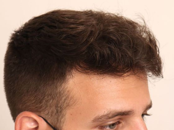 Male Before And After Hair Transplant Photos Hairline FUE  - After