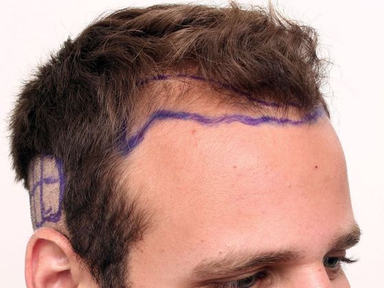 Male Before And After Hair Transplant Photos Hairline FUE  - Before