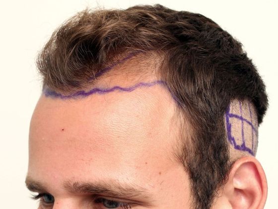 Hair Transplant - Male: Hairline FUE - Case 1 - Before FUE hair transplant