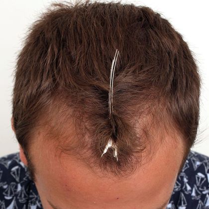 Hair Transplant - Male: Hairline FUE - Case 1 - Before FUE 