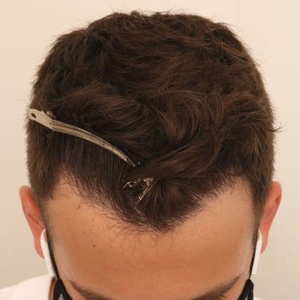 Hair Transplant - Male: Hairline FUE - Case 1 - After FUE hair transplant