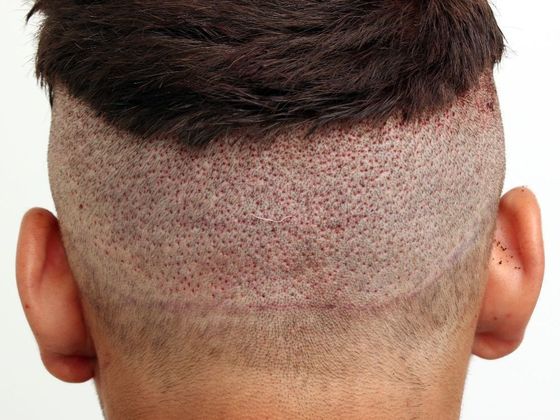 Hair Transplant - Male: Hairline FUE - Case 1 - Donor view post-op FUE