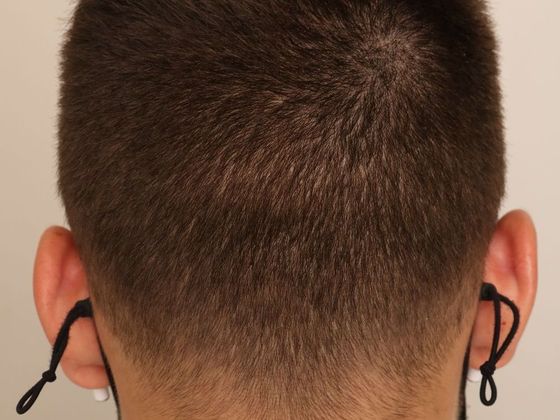 Hair Transplant - Male: Hairline FUE - Case 1 - Donor healed after FUE