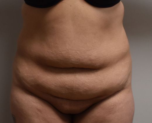 Tummy Tuck (Abdominoplasty): Case 248 - Before