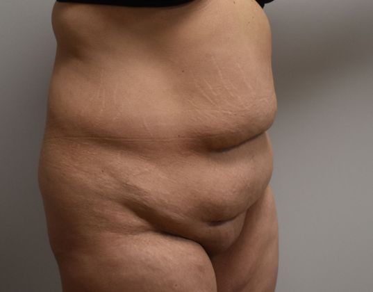 Tummy Tuck (Abdominoplasty): Case 248 - Before