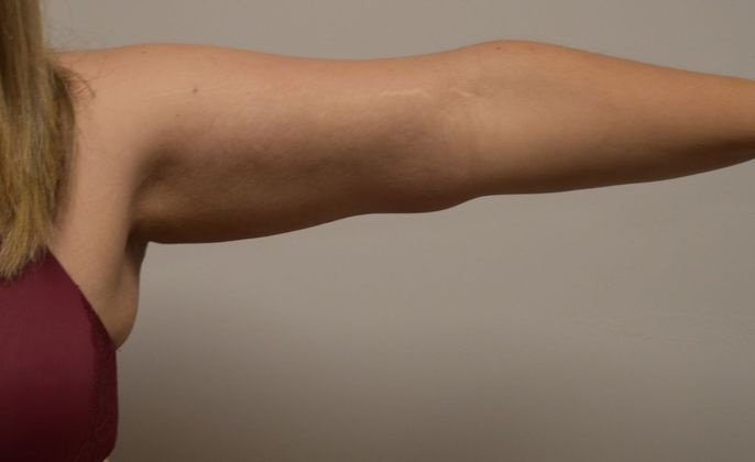 Brachioplasty Case 12 - After