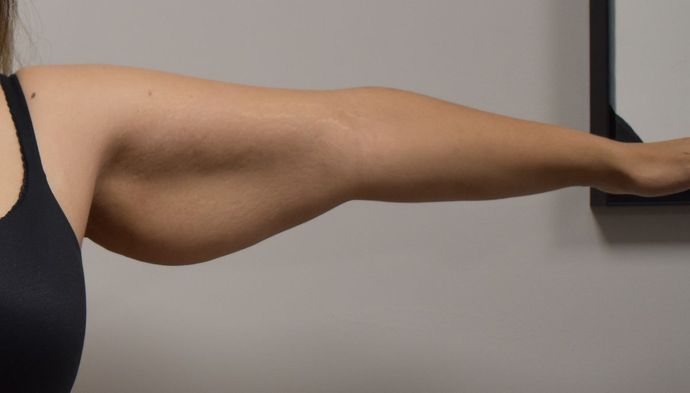 Brachioplasty Case 12 - Before