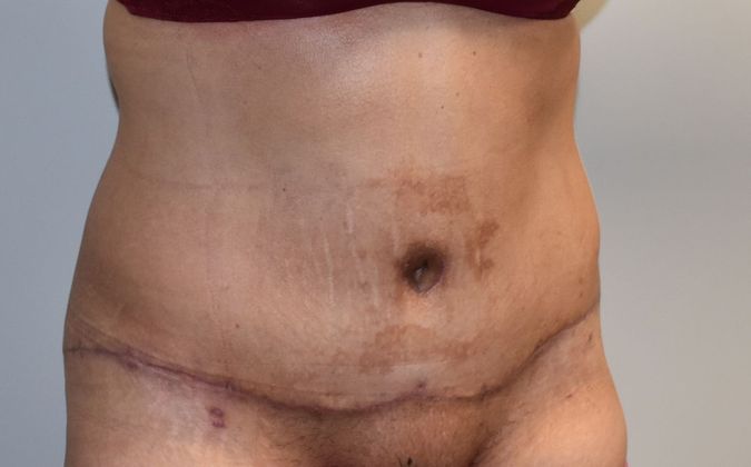 Massive Weight Loss : Case 75 - After