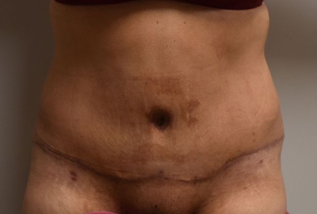 Massive Weight Loss : Case 75 - After
