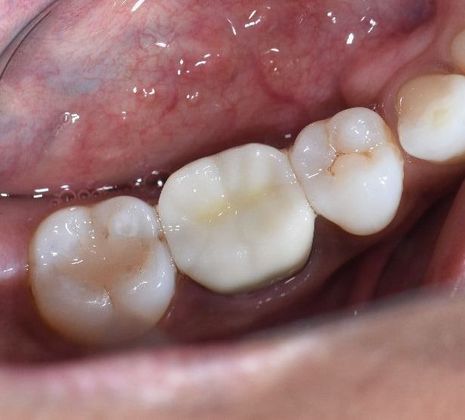 Crowns Case 3 - Victoria, TX - After