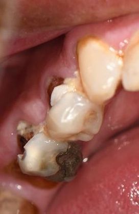 Crowns Case 4 - Yoakum, TX - Before