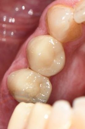 Crowns Case 4 - Yoakum, TX - After