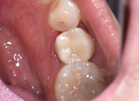 Crowns Case 7 - Goliad, TX - After