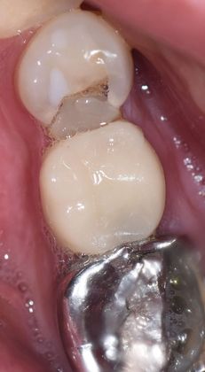 Crowns Case 8 - Victoria, TX - Before