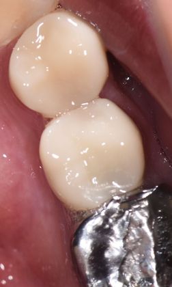 Crowns Case 8 - Victoria, TX - After