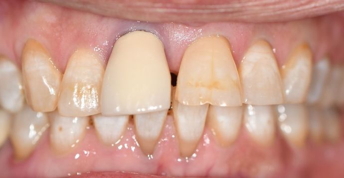 Crowns: Case 6 - Victoria, TX - Before