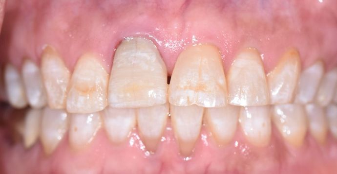 Crowns: Case 6 - Victoria, TX - After