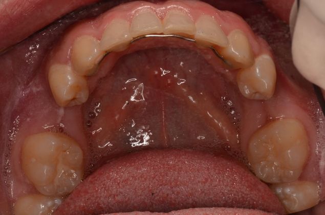 Dental Implants Case 40 - Before