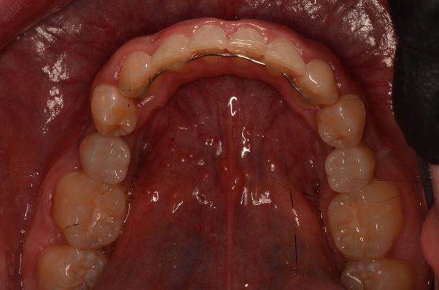 Dental Implants Case 40 - After