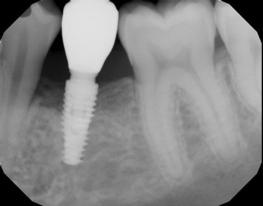 Dental Implants: Case 40 - After screw retained crown