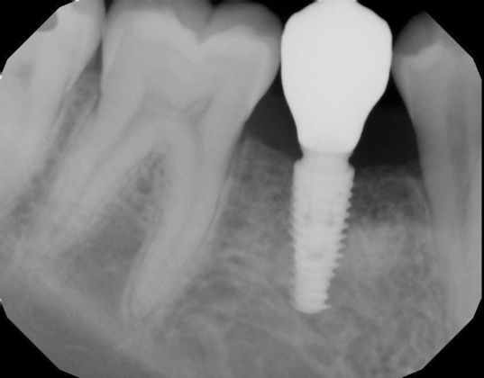 Dental Implants: Case 40 - After screw retained crown