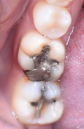 Crowns Case 9 - Victoria, TX - Before