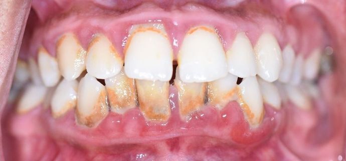 Periodontal Cleaning: Case 9 - Victoria, TX - Before
