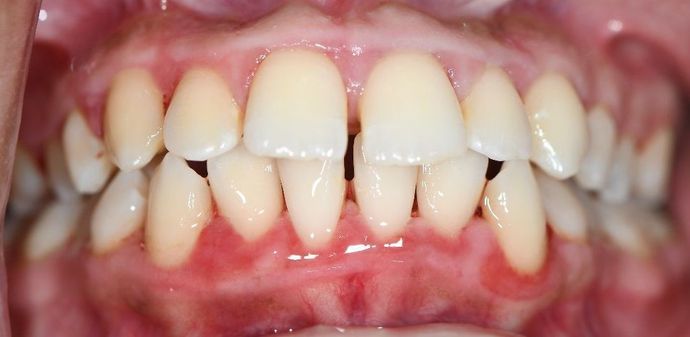 Periodontal Cleaning: Case 9 - Victoria, TX - After