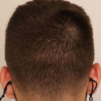 Hair Transplant - Donor Area Afters: FUE - After 2723 FUE extractons