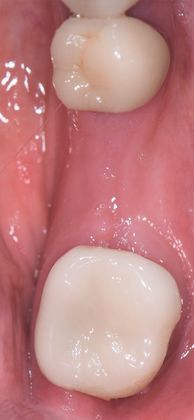 Dental Implants: Case 4 - Corpus Christi, TX - Before