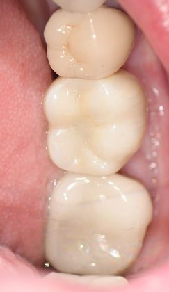 Dental Implants: Case 4 - Corpus Christi, TX - After