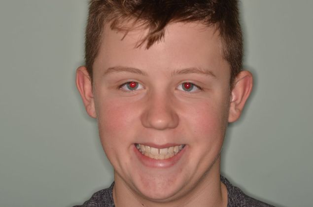 Invisalign: Case 13 - Before invisalign with front Diastema