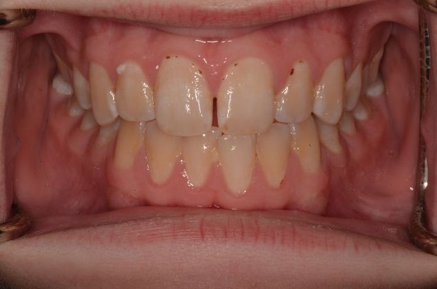 Invisalign: Case 13 - Before invisalign with front Diastema