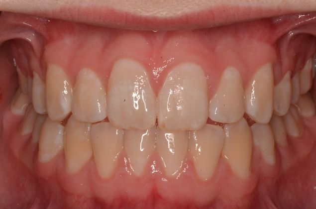 Invisalign: Case 13 - After invisalign (orthodontics)
