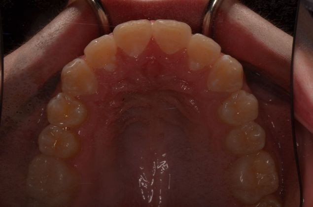 Invisalign: Case 13 - After correction of upper teeth with invisalign